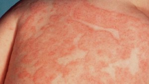 Как вылечиться от атопического дерматита в домашних условиях thumbnail