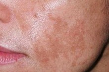 Почему появляются белые пятна на коже после загара и как лечить