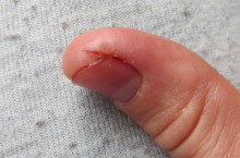 Трещины на пальцах рук возле ногтей, причины и лечение заболевания