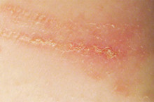 Аллергический контактный дерматит – заболевание замедленной формы