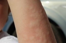 Все про аллергически дерматит у детей