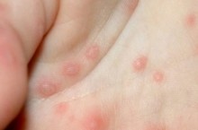 Особенности буллезного дерматита
