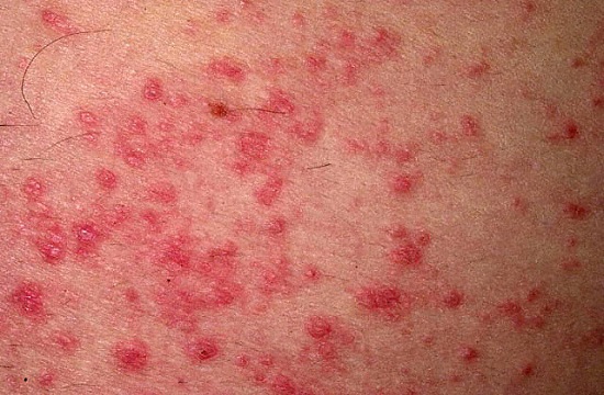 Все про аллергический дерматит thumbnail