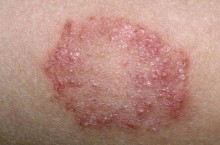 Грибковый дерматит, чем вызвано данное заболевание?