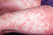 Токсико-аллергический дерматит, что из себя представляет?