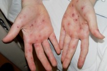 Все про атопический дерматит на лице и руках