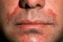 Пероральный дерматит на лице, симптомы и способы лечение