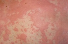 Солнечный дерматит (фотодерматит), причины возникновения и возможные последствия