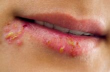 Прыщик на губе и это не герпес — какие могут быть причины и как лечить