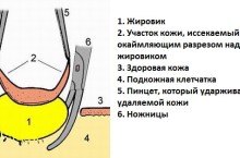 Можно ли вылечить жировик на мочке уха и что делать, если он воспалился?